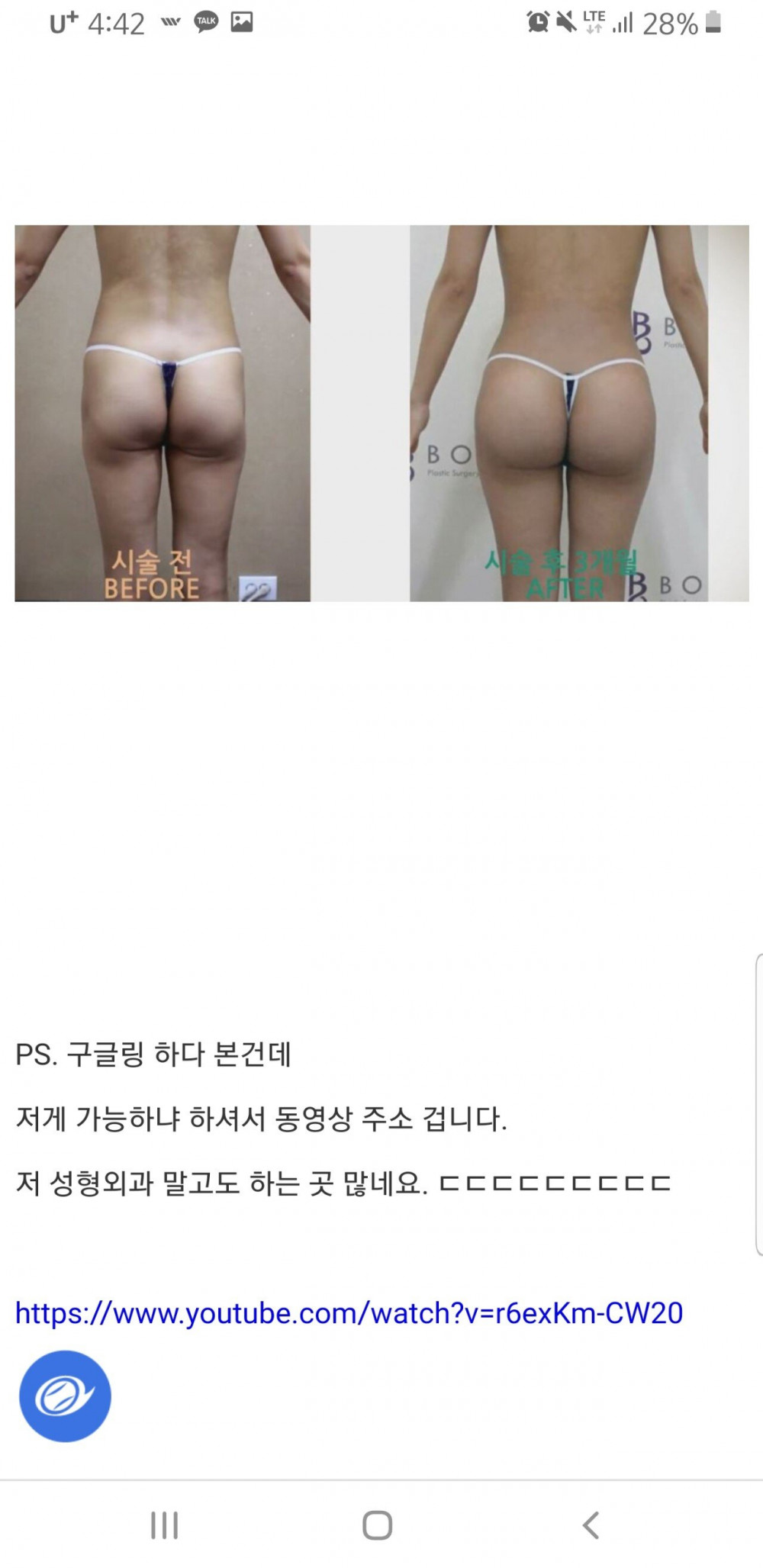 골반 성형 개지리네 ㅋㅋㅋㅋ