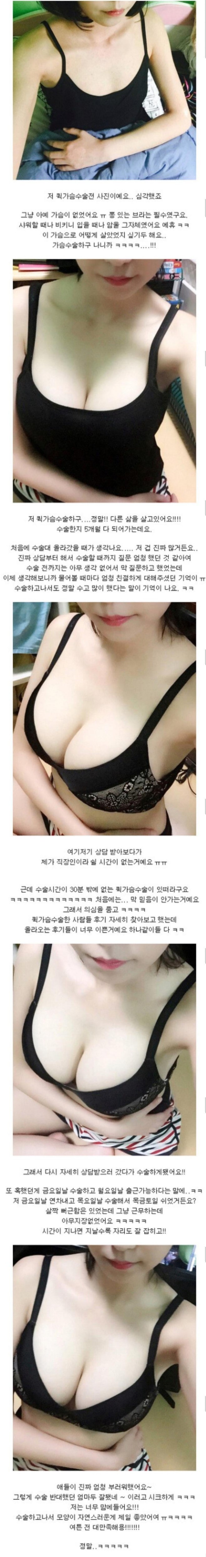 어느 여대생의 퀵가슴수술 후기