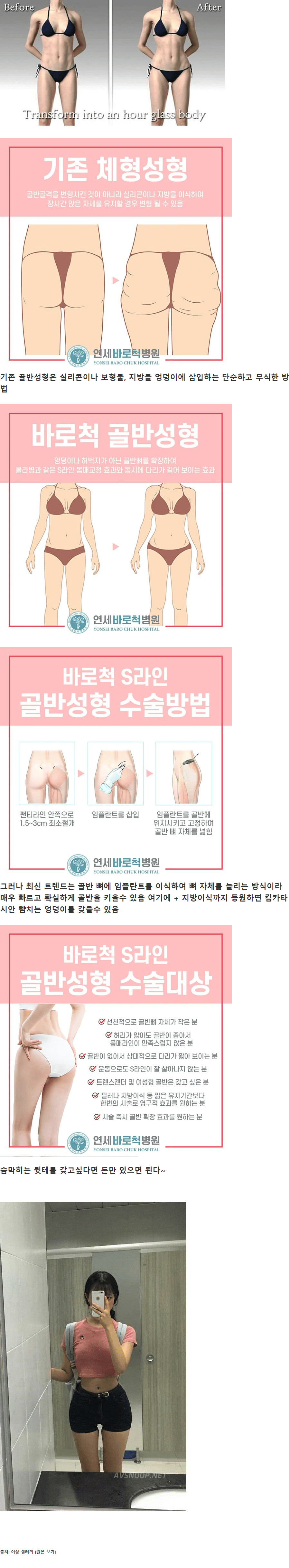 요즘 골반 성형하는 방법