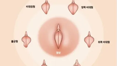 소음순 정리