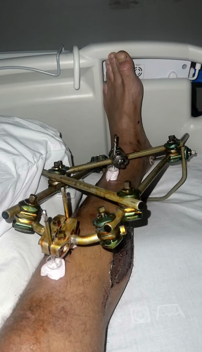 英 BBC 충격, 음주운전 女 차량에 치인 축구선수 ‘다리 절단’→EPL 유망주 이른 나이 은퇴