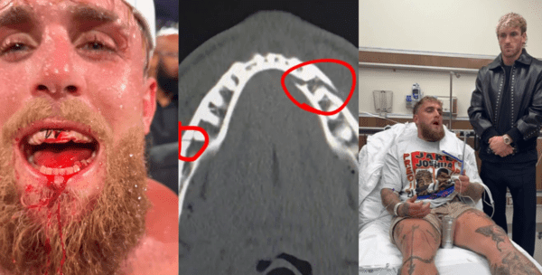 ‘2090만 유튜버 복서’ 폴, 턱뼈 골절이 문제가 아니다…“우울증·뇌기능 장애 우려” 복싱 그만둬야