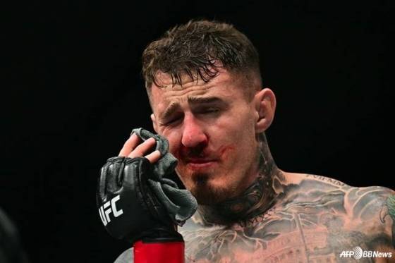 '은퇴 시사' 눈 찔려 실명위기 UFC 챔피언, 깜짝 폭탄발언