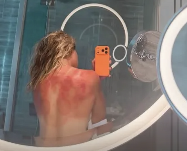 한국인 최다 여행 검색 국가…테니스 선수 끔찍한 햇볕 화상 자국→상반신 탈의 공개 “태양이 장난 아니다” 