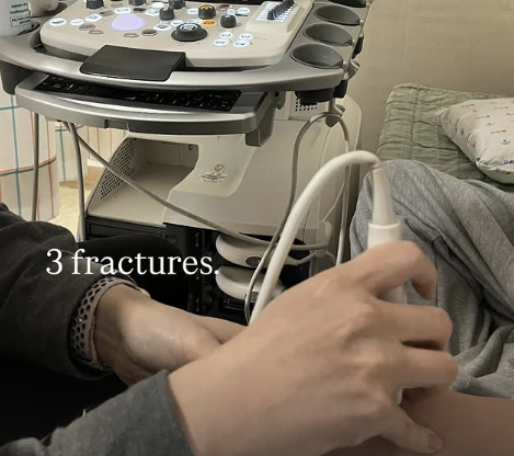 '금메달' 최가온, 골절상 진단 나왔다…SNS에 진단 결과 암시→'투혼의 올림픽 챔피언' 더더욱 감동 [2026 밀라노]