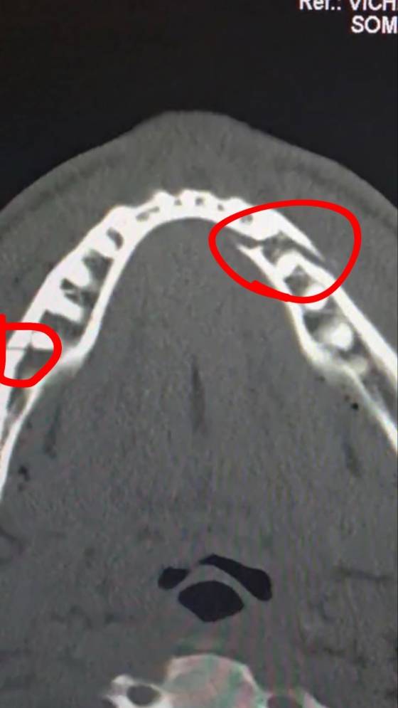 턱뼈 부서지게 두들겨 맞고 '1360억 잭팟'→또 역대급 매치 깜짝 선언