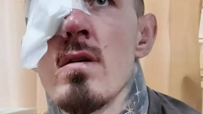 충격의 은퇴 시사, 오른쪽 눈 보이지 않아, 왼쪽 눈 시력 절반 잃어...아스피날, 영구적 손상 진단 시 떠날 것