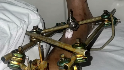 英 BBC 충격, 음주운전 女 차량에 치인 축구선수 ‘다리 절단’→EPL 유망주 이른 나이 은퇴