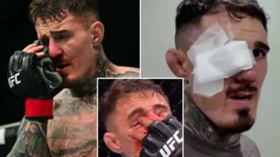 그 더러운 손 때문에... UFC 챔피언 끝내 '양쪽 눈' 모두 수술→회복 못 하면 은퇴 초강수