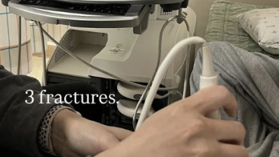 '금메달' 최가온, 골절상 진단 나왔다…SNS에 진단 결과 암시→'투혼의 올림픽 챔피언' 더더욱 감동 [2026 밀라노]