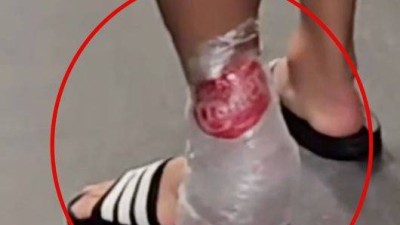 이래놓고 항의를 해? 손흥민, 아킬레스건 직격→얼음 대고 절뚝절뚝...발에 자국 남아있더라 위험한 태클에 부상 우려